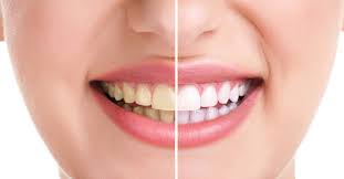 Teeth Whitening & Bleaching